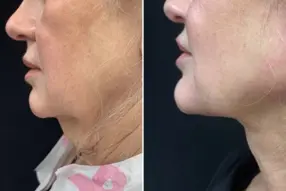 Before and after Renuvion neck treatment by Dr. Drew Varano in Washington DC