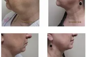 Before and after of Renuvion( J -Plasma) neck treatment by Dr. Drew Varano in Washington DC