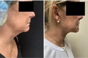 Before and after results Renuvion (J -Plasma) neck treatment by Dr. Drew Varano in Washington DC