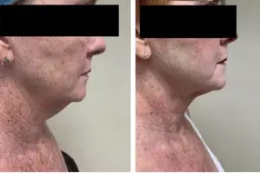 Before and after of  Renuvion( J -Plasma) neck treatment by Dr. Drew Varano in Washington DC