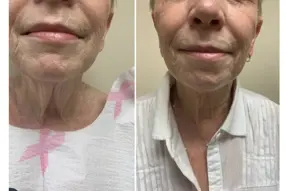 Before and after of  Renuvion(J -Plasma) neck treatment by Dr. Drew Varano in Washington DC