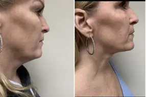 Before and after of  Renuvion( J -Plasma) neck treatment by Dr. Drew Varano in Washington DC