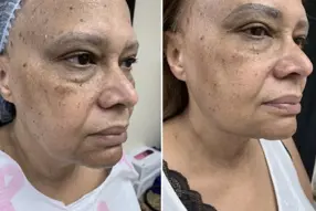 Before and after of Renuvion( J -Plasma) lower face and neck treatment by Dr. Drew Varano in Washington DC