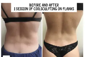Coolsculpting Results Washington DC-Medical Cosmetic Enhancements