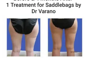 Before and after Coolsculpting thighs treatment by Medical Cosmetic Enhancementsin Washington DC
