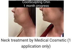 Before and after Coolsculpting treatment double chin by Medical Cosmetic Enhancementsin Washington DC
