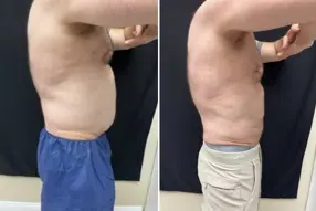 Before and after  Liposuction Male by Medical Cosmetic Enhancements Dr Varano in Washington DC