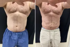 Before and after  Liposuction Male by Medical Cosmetic Enhancements Dr Varano in Washington DC