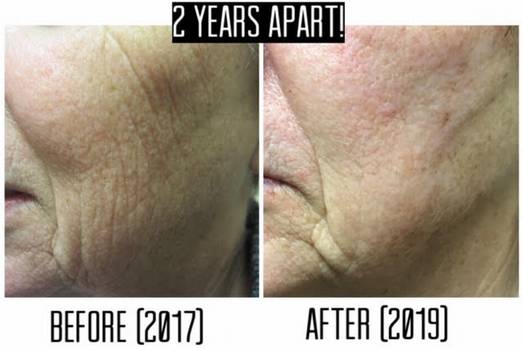 Fractional CO2 Treatment