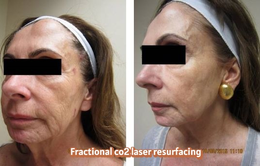 Fractional CO2 Treatment (Mixto) for Face