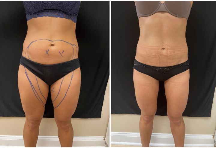 Inner/outer thighs & lower abdomen 2 months