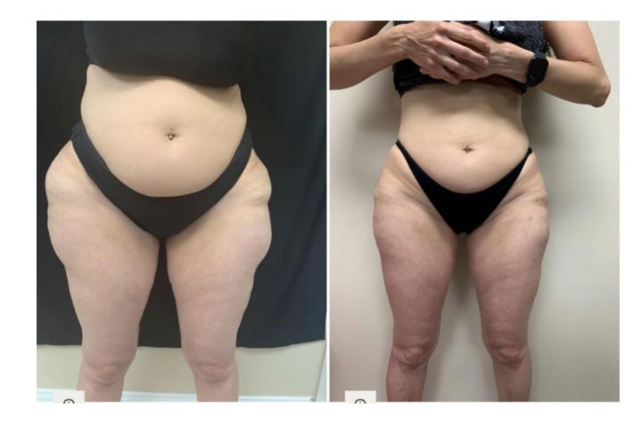 Inner/outer thighs  2 months apart